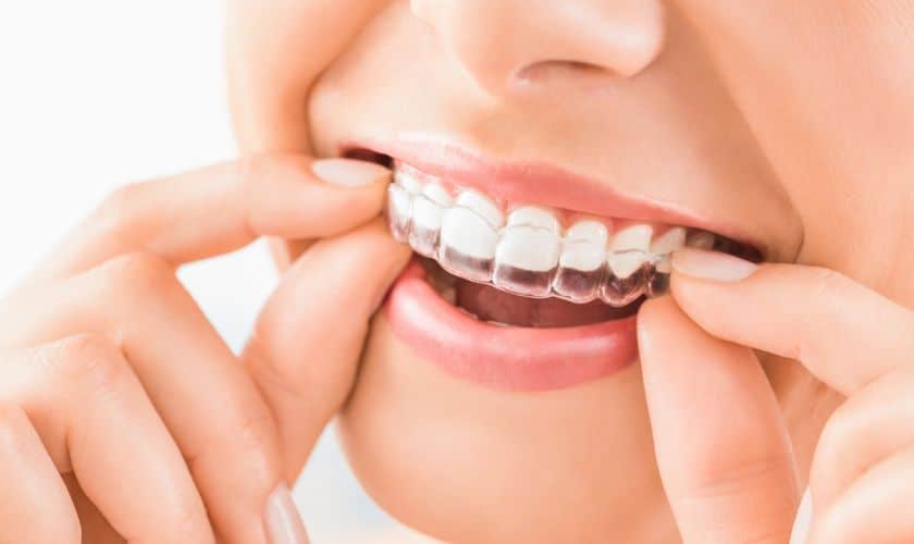 What To Expect During Your Clear Aligner Treatment