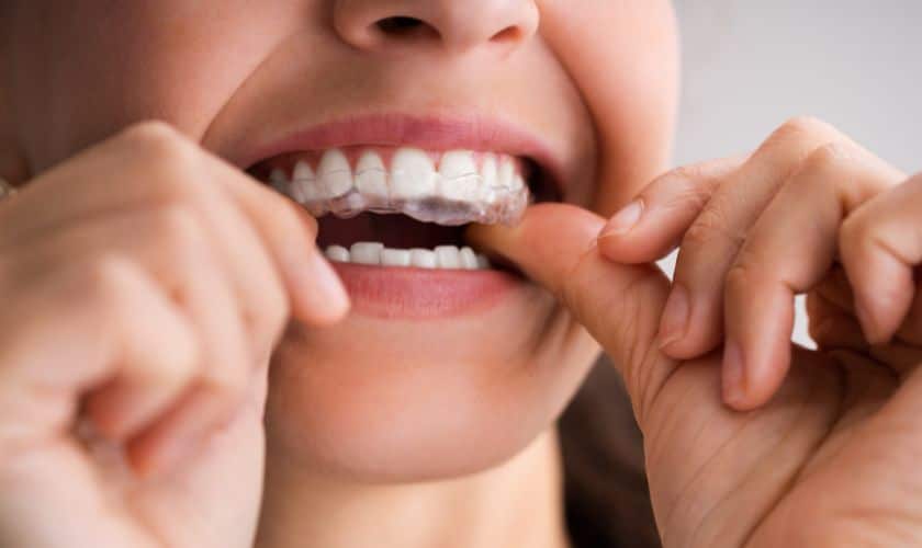 Benefits Of Clear Aligners Over Traditional Braces