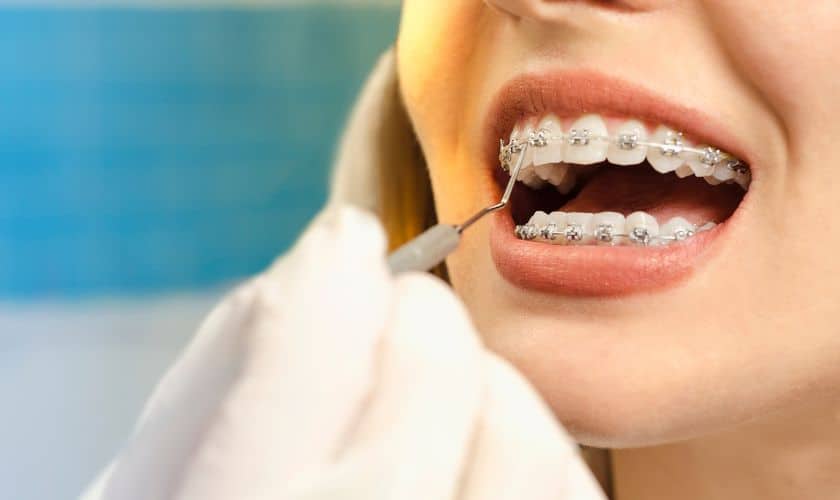 Orthodontic Myths Debunked: What You Should Know About Braces