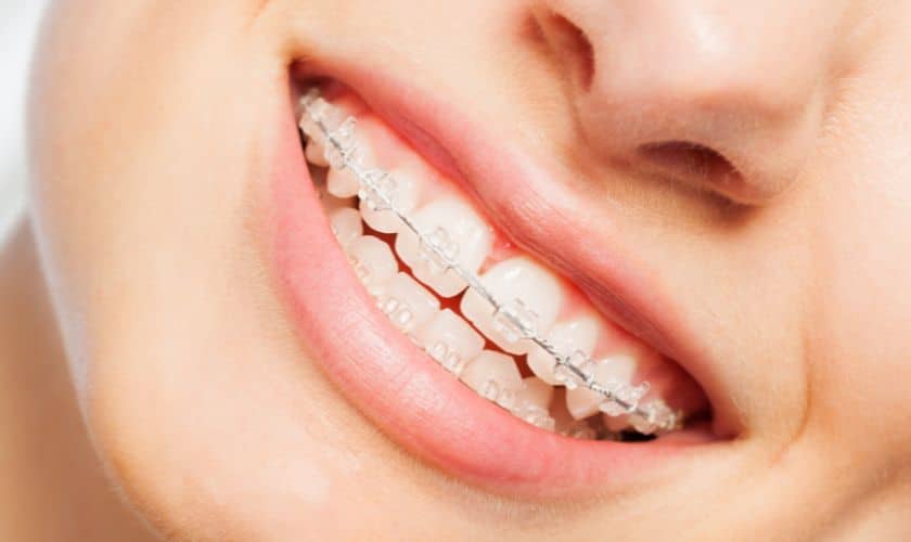 Benefits Of Clear Braces: A Discreet Solution For Straightening Your Smile